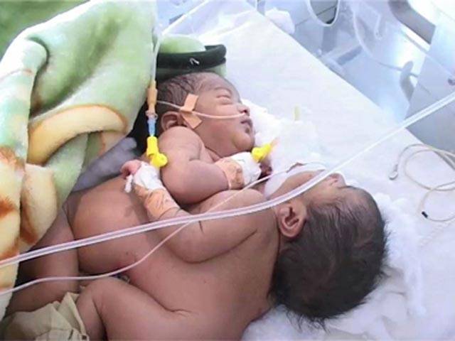 Conjoined baby girls die in Karachi hospital