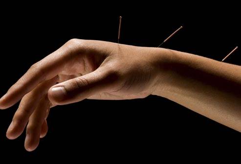Acupuncture reduces high blood pressure 