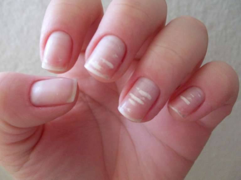 The actual reason of those white marks on our nails isn't Calcium deficiency