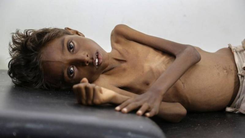 Yemen's children starve as war drags on