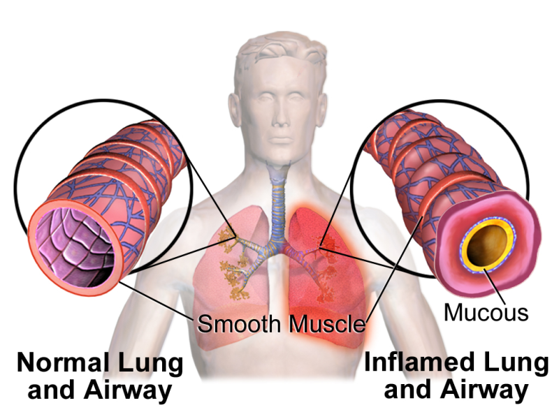 Lung Disease – take it seriously