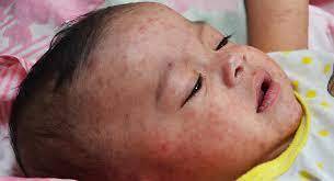 Measles outbreak kills three-year-old in proximal village of Shikarpur
