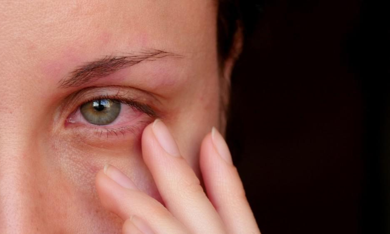  85 new cases of Pink Eye infection reported in Lahore