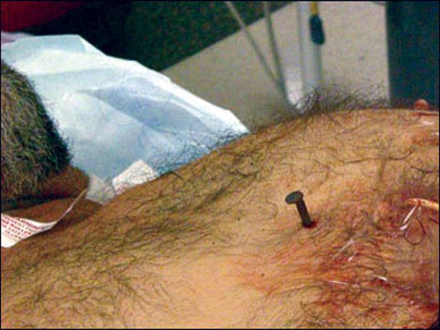 Man survives 4-inch nail in heart