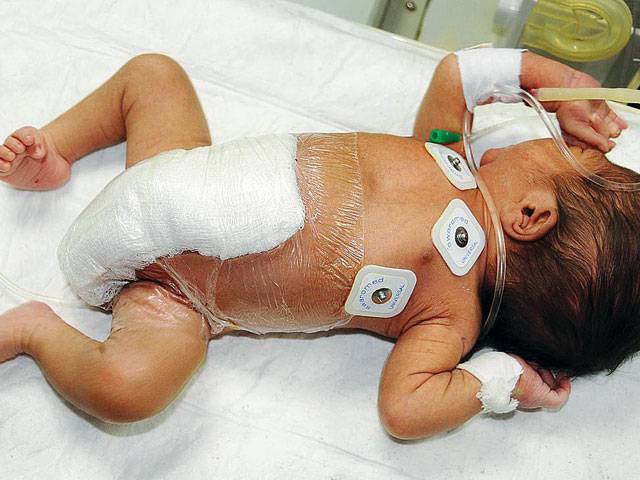 Doctors save six-legged baby’s life 