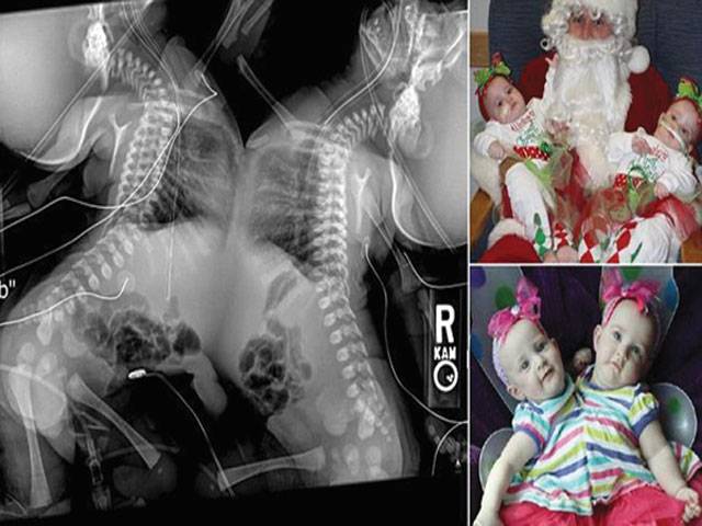 Conjoined twin girls separated successfully