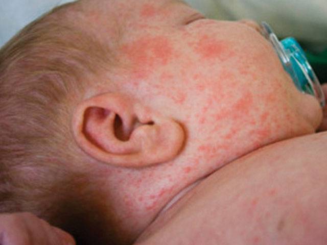  102 MORE measles PATIENTS drop IN 