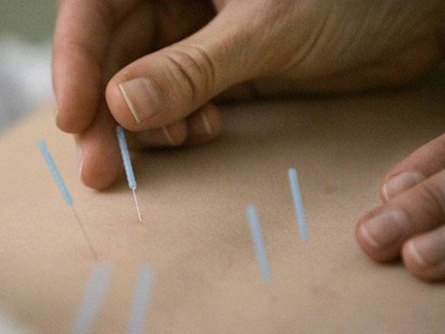 Acupuncture therapy best treatment for diseases: experts 