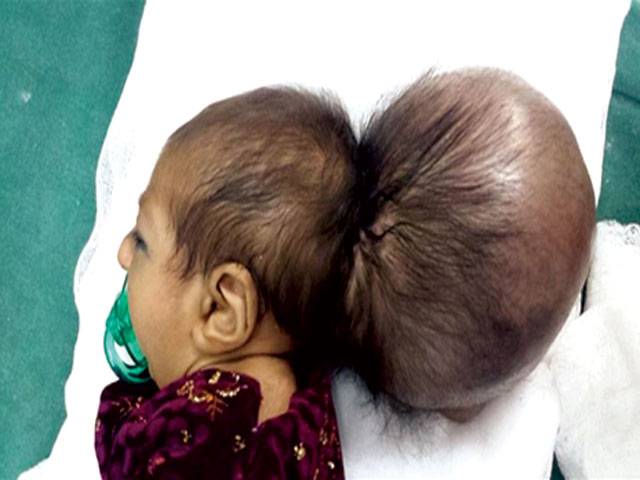 Afghan docs’ successful surgery of ‘two-headed’ baby
