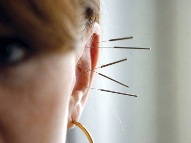 Ear acupuncture aids weight loss