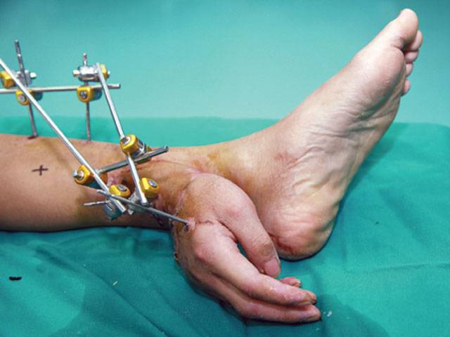 Man’s leg proves handy solution after arm severed