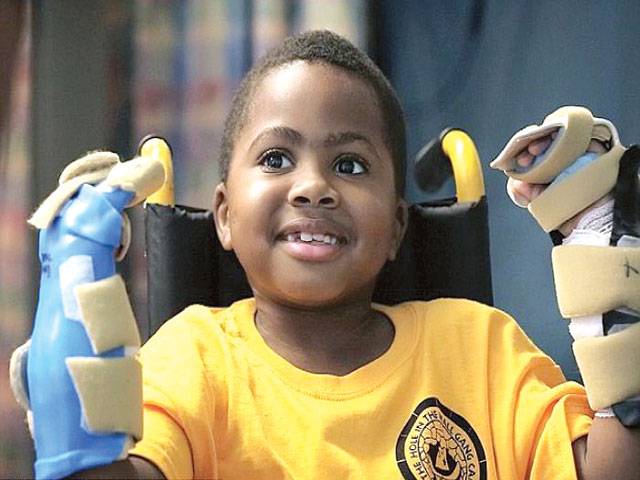 First child double hand transplant