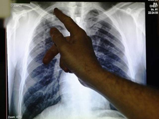 Tuberculosis deaths ‘unacceptably high’