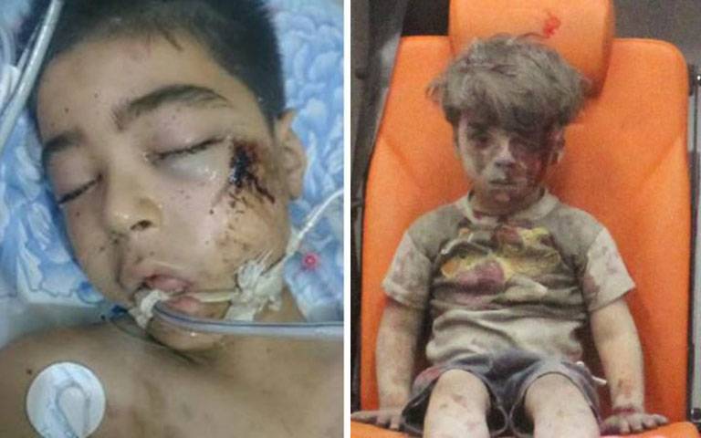 Omran’s brother Ali dies form wounds