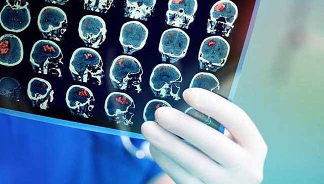 Baby brain scans may reveal autism risk 