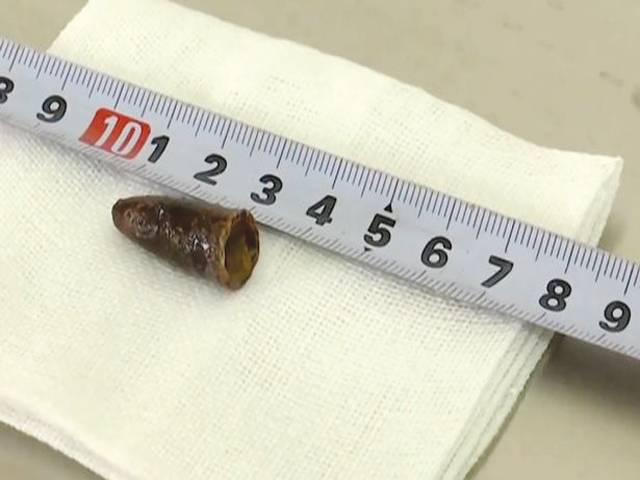 Pen cap found in patient’s lung after 20 years