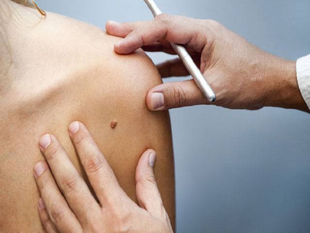 Australian researchers say they can stop melanoma spreading
