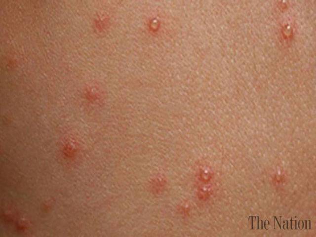 Rise in chickenpox cases raises alarm