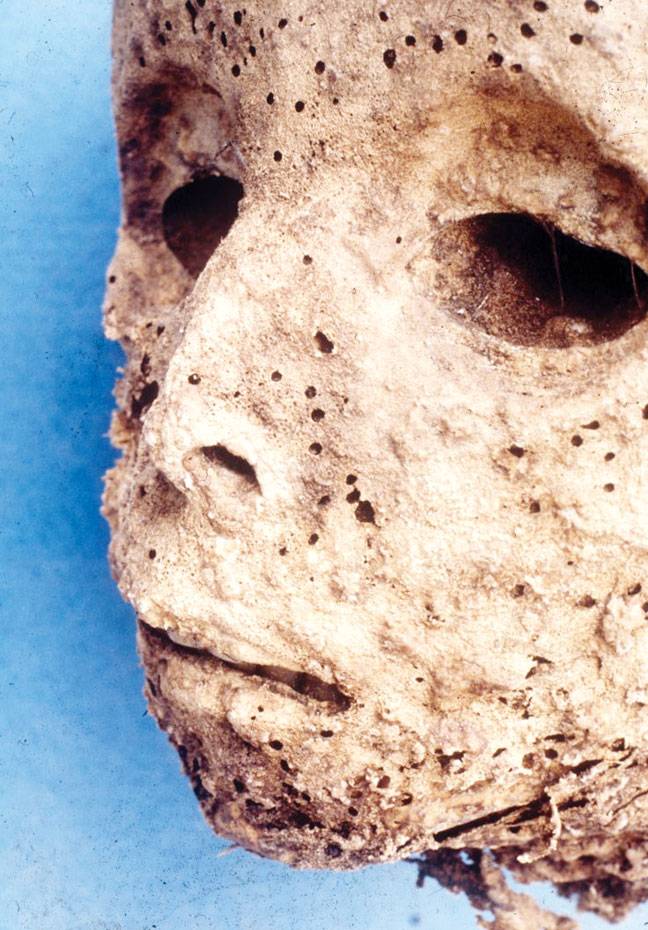 Child mummy in Italy had hepatitis, not smallpox