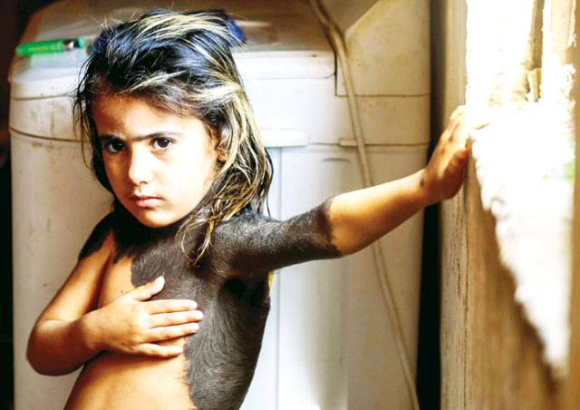 In an Iraqi village, a little girl hides skin disease from neighbours