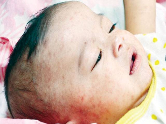 Measles cases hit record high in Europe 