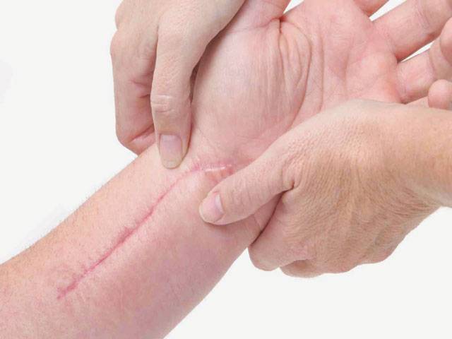 Breakthrough study ‘grows’ skin from tissue to heal wounds