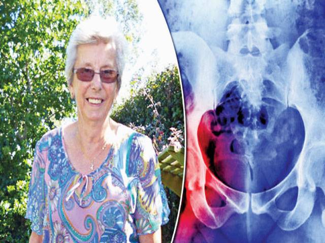 US scientists find potential treatment of osteoporosis