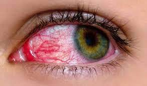 Punjab reports over 10,000 new cases of pink eye infection